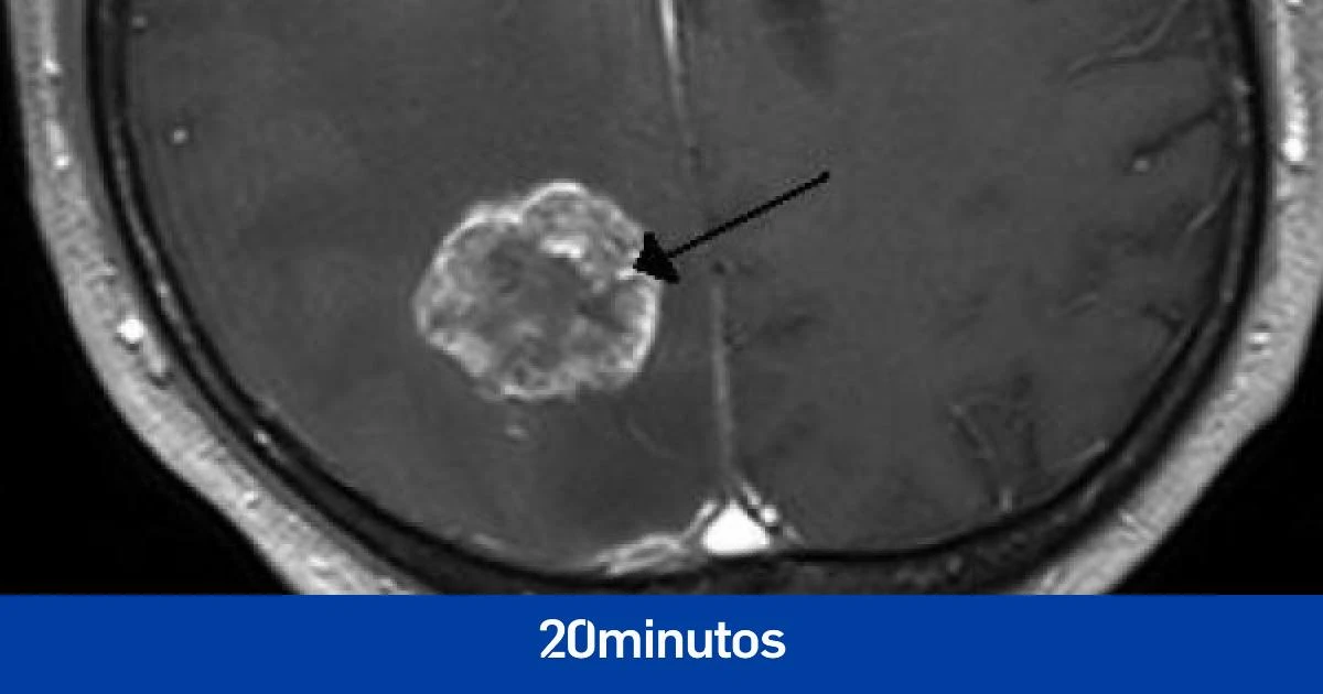 Científicos españoles descubren qué causa la resistencia a la 'radio' en casos de metástasis cerebral y un fármaco para revertirla