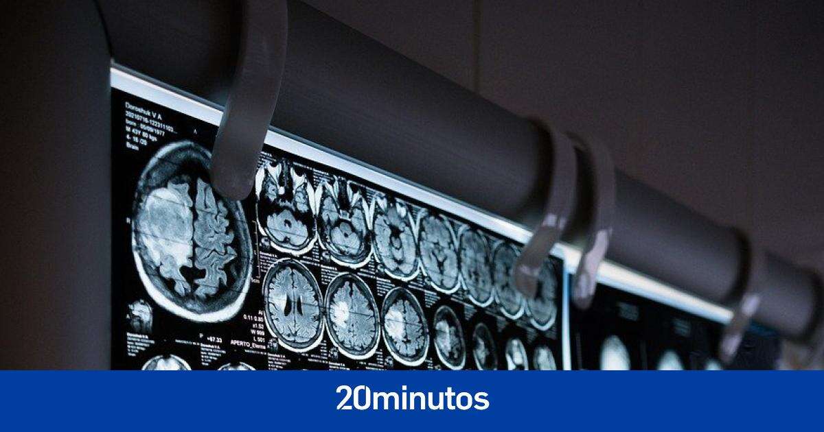 Una farmacéutica japonesa constata el éxito de un nuevo tratamiento para ralentizar el avance del alzhéimer