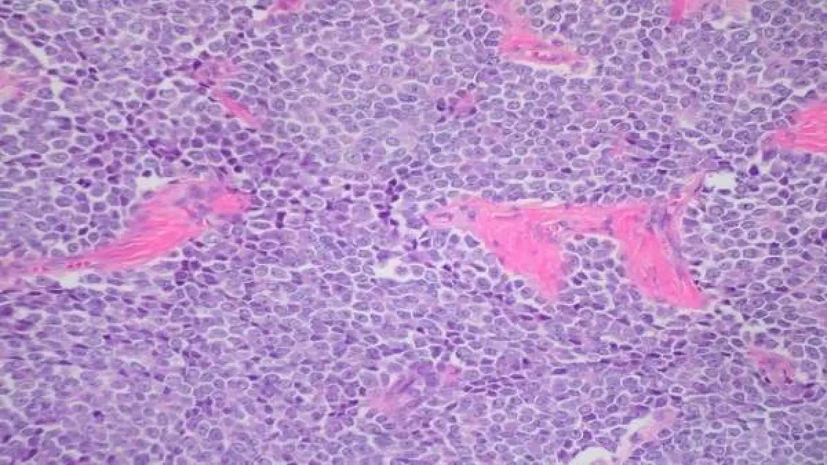 Descubierto el gen que propicia el desarrollo del sarcoma de Ewing, un cáncer de huesos y tejidos blandos