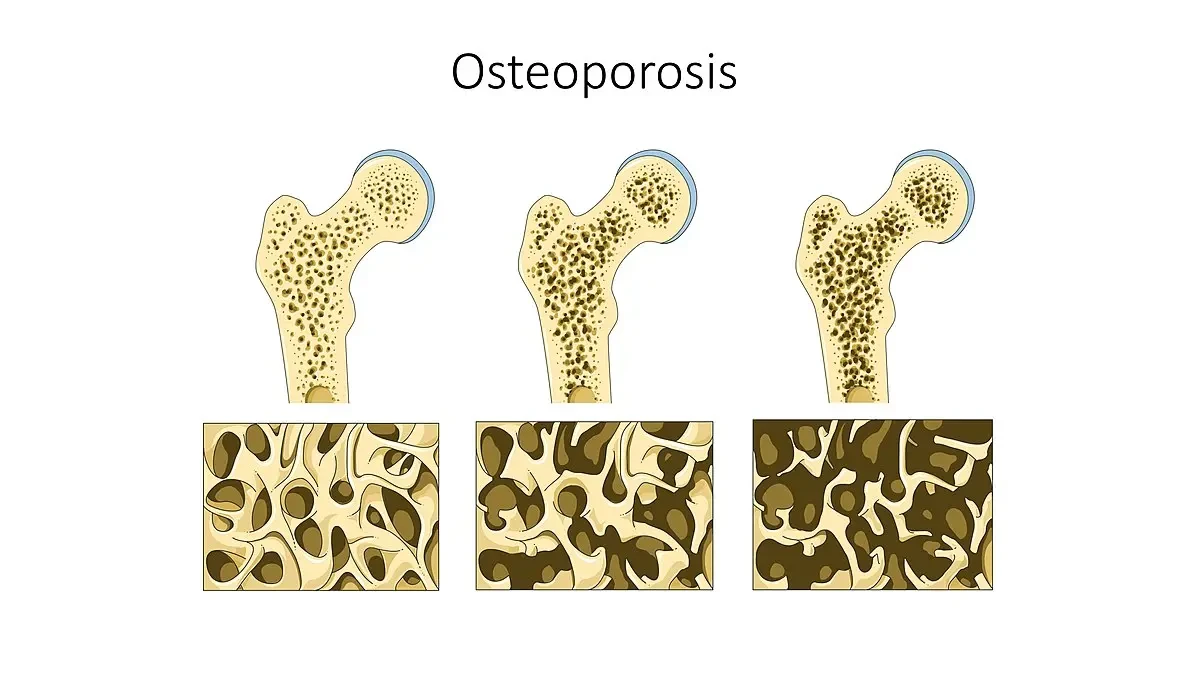 Cómo combatir la peligrosa osteoporosis