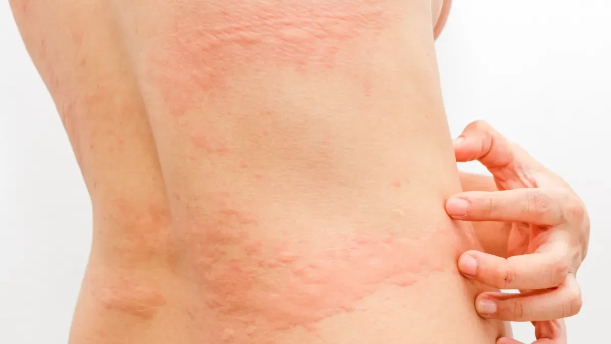 Un estudio advierte de síntomas cutáneos de larga duración en pacientes con coronavirus