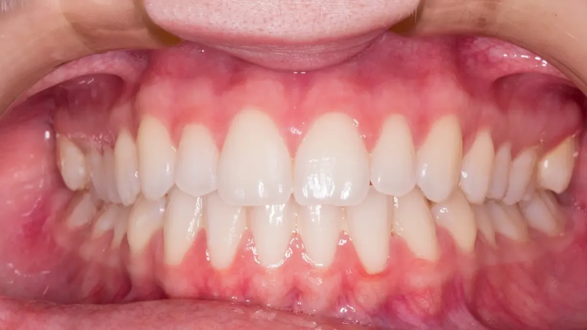 Los cuatro problemas en los dientes que aparecen tras el verano
