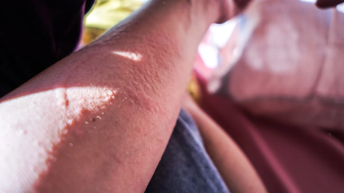 La ‘alergia’ al sol en verano: qué es realmente y cómo tratarla