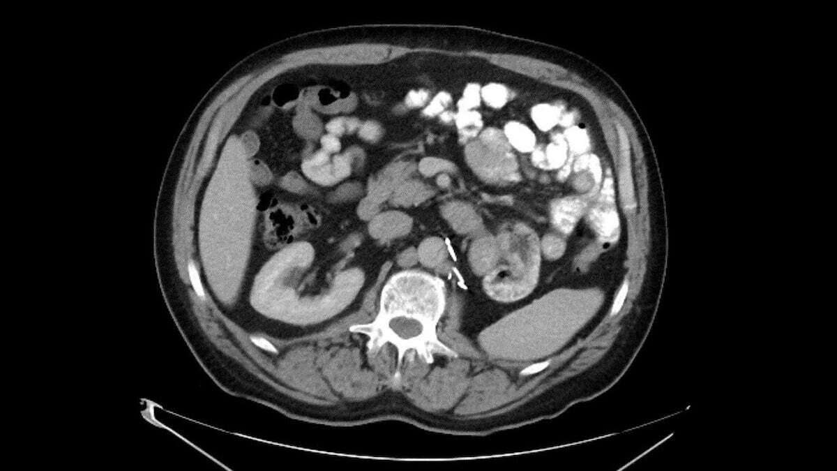 Una vacuna experimental logra frenar la recaída en cáncer de riñón avanzado