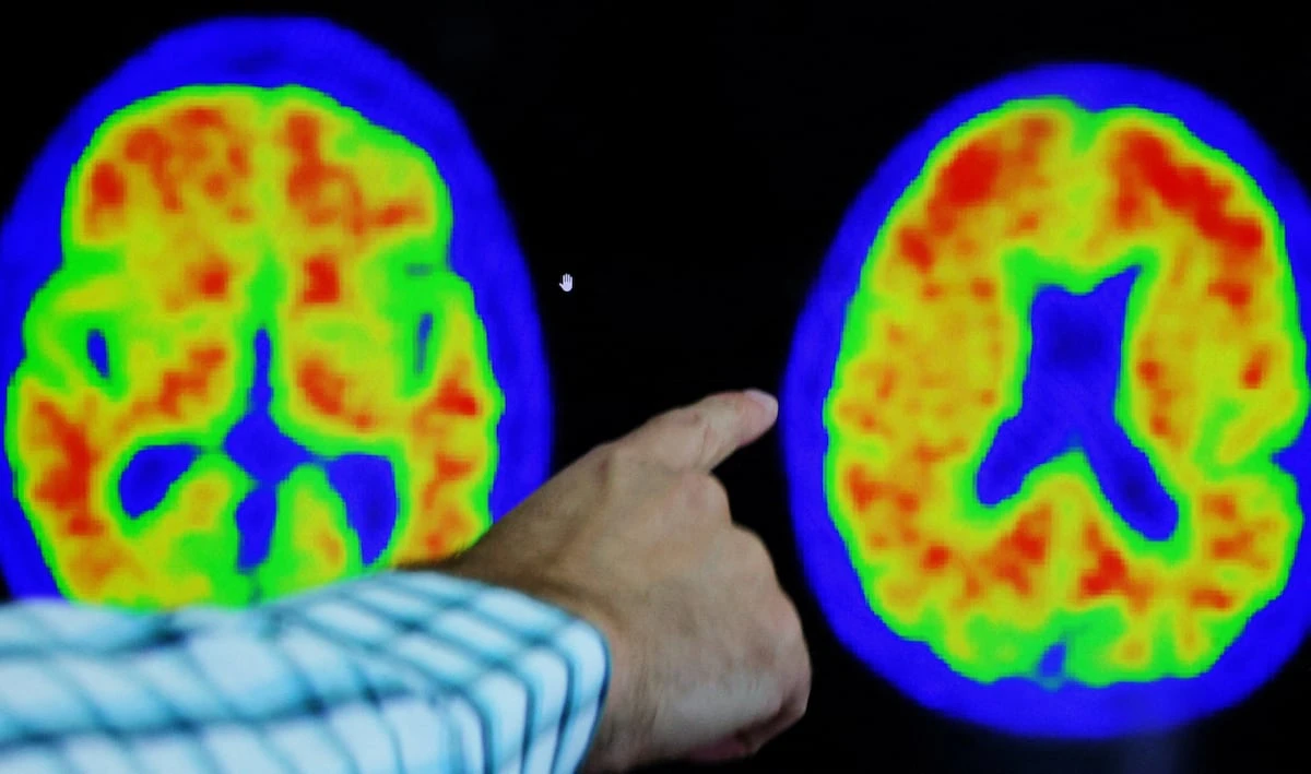 Un gigantesco mapa molecular abre el camino para curar el alzhéimer y el párkinson