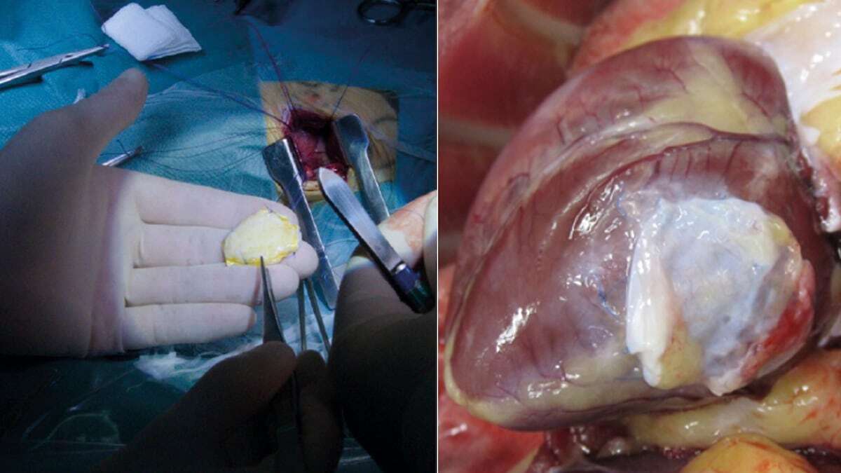 Un parche de células ajenas implantado a una mujer demuestra que es posible regenerar el corazón humano