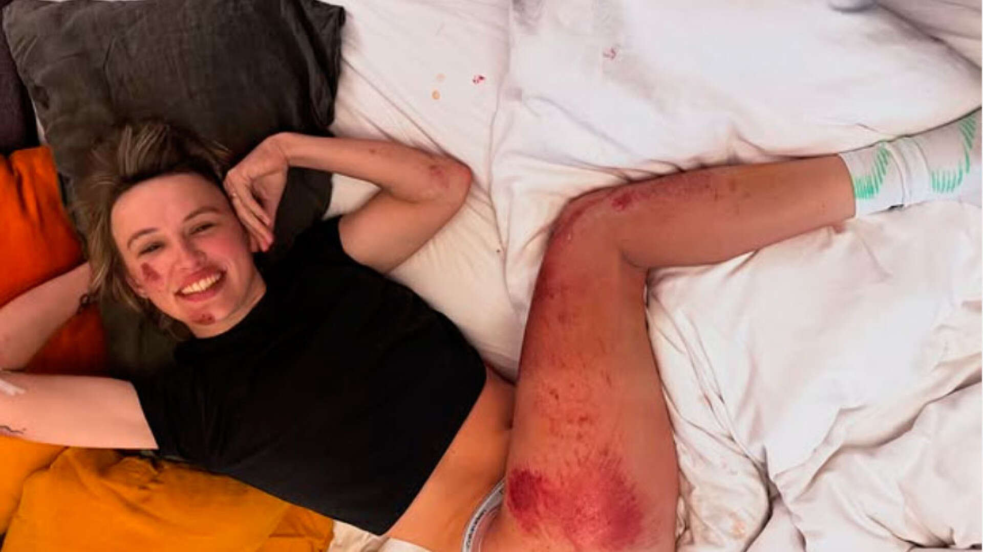 Las dolorosas heridas de Katarzyna Niewiadoma tras su caída en la Strade Bianche: 