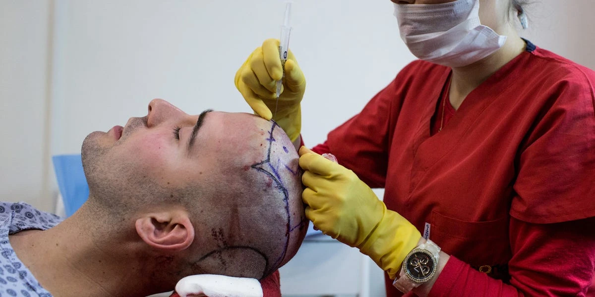 Why hair transplants are so expensive