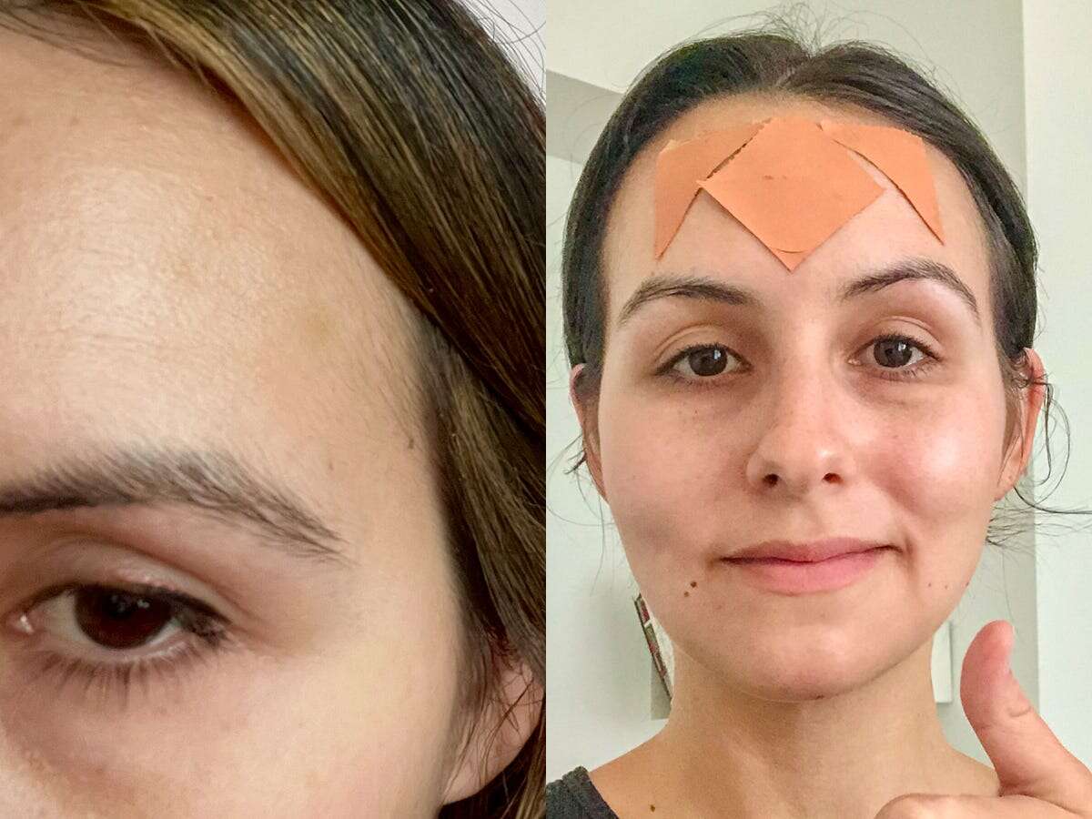 I tried both Botox and face tape for my forehead lines. Neither is perfect, but one feels better in the long run. 