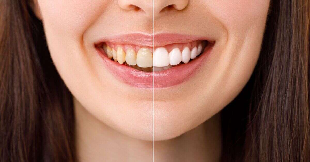 El precio de una sonrisa perfecta: Lo que no te dicen del blanqueamiento dental