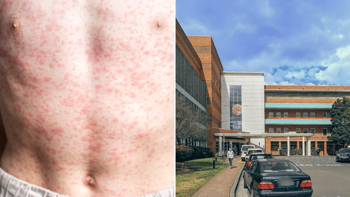Measles alert after returned traveller visits hospital, hotel