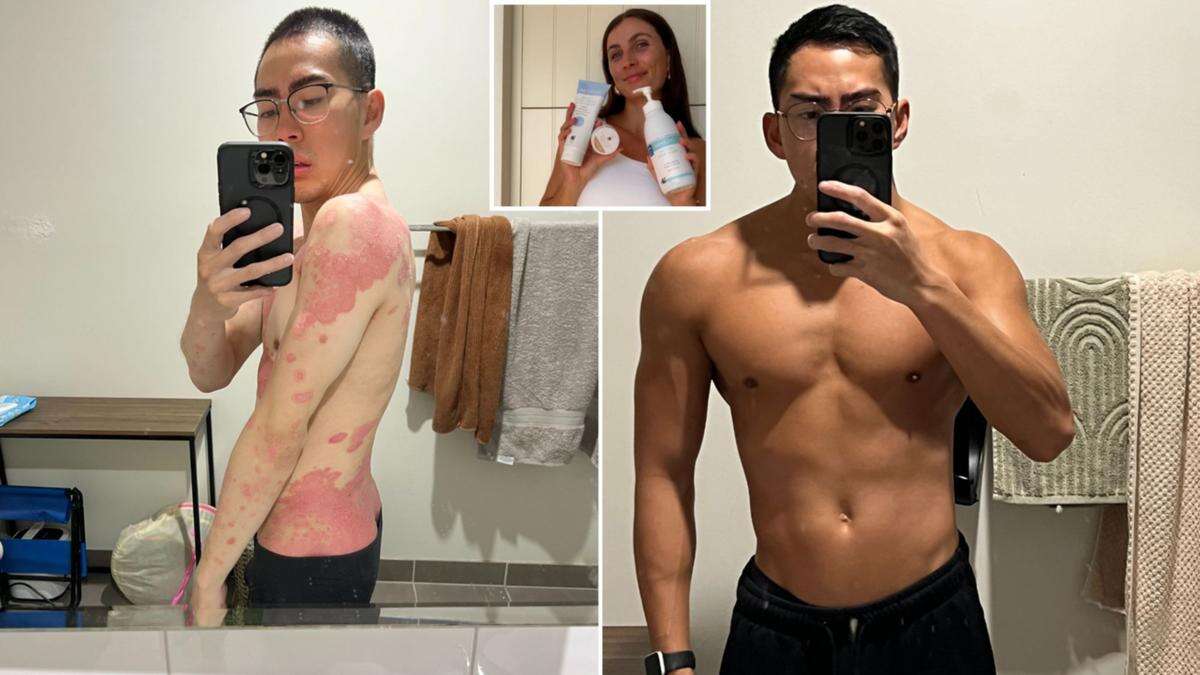 The $25.50 cream and diet plan that helped a young Aussie struggling with severe psoriasis