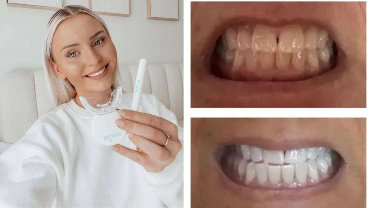 Brighten your smile in six days with dentist-approved teeth whitening kit while it’s 50% off