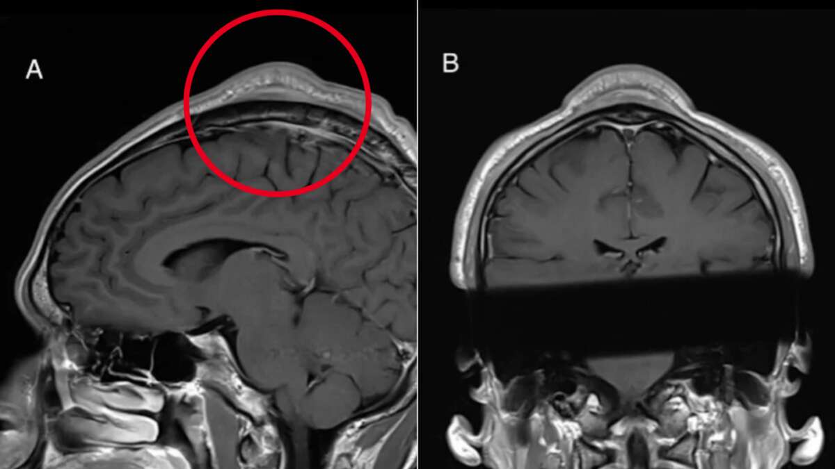 Grim discovery in breakdancer’s X-ray after spinning on his head for years