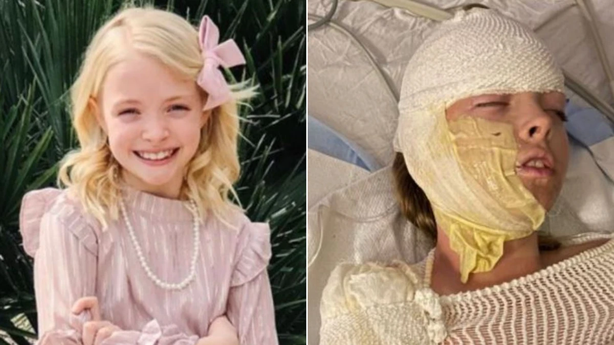 Girl, 10, left with severe burns to half her body after gas tank explodes at party