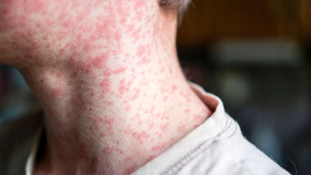 Health alert across NSW after person with ‘highly infectious’ disease visits multiple locations