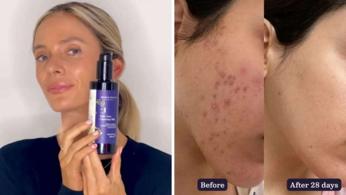 This Aussie-made product is the solution for acne-prone skin