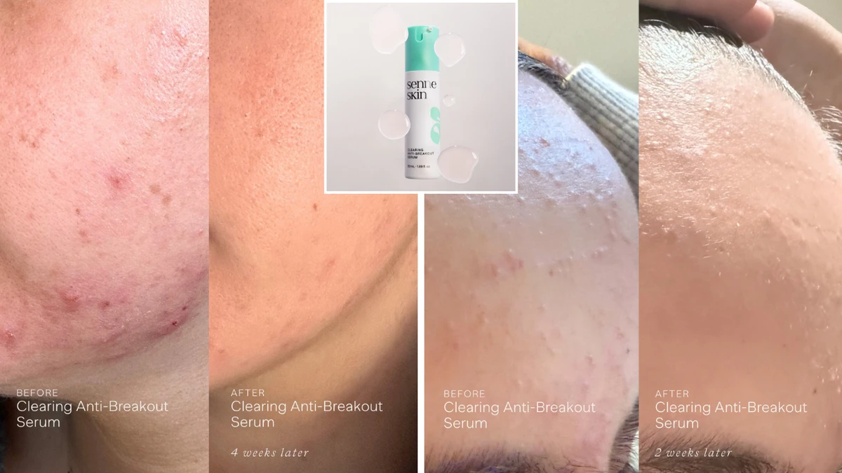 Sensitive skin approved product clears skin in four weeks: ‘It’s my holy-grail’