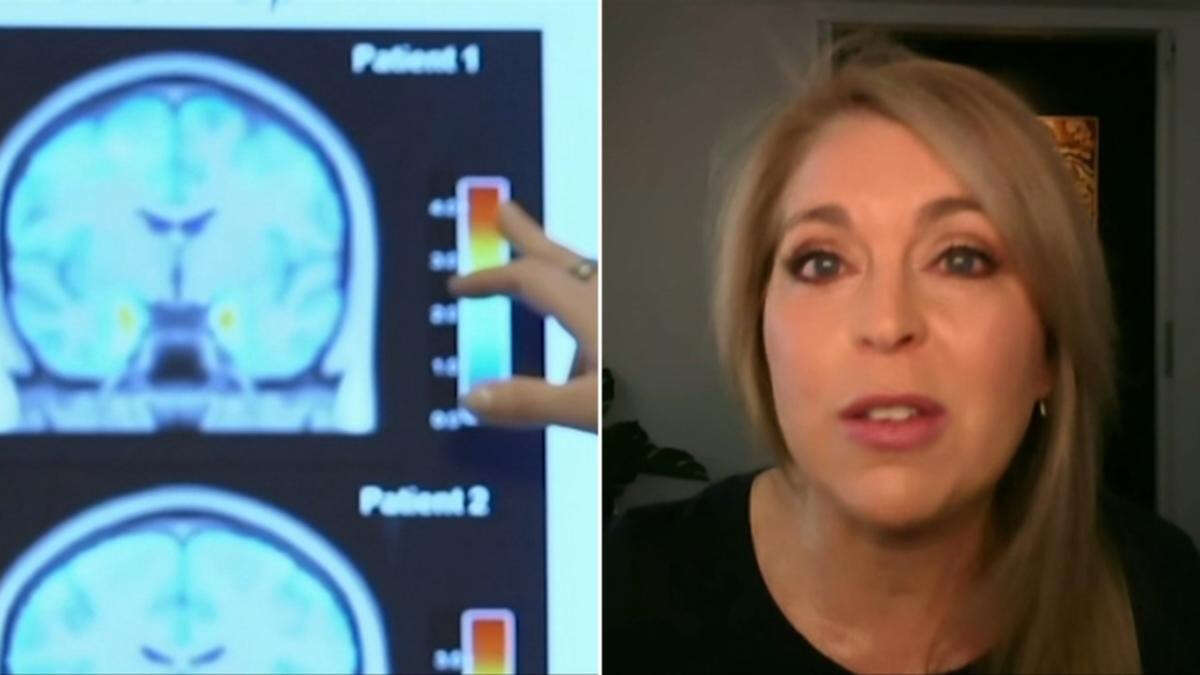 Doctor breaks down the truth about simple blood test to diagnose Alzheimer’s disease