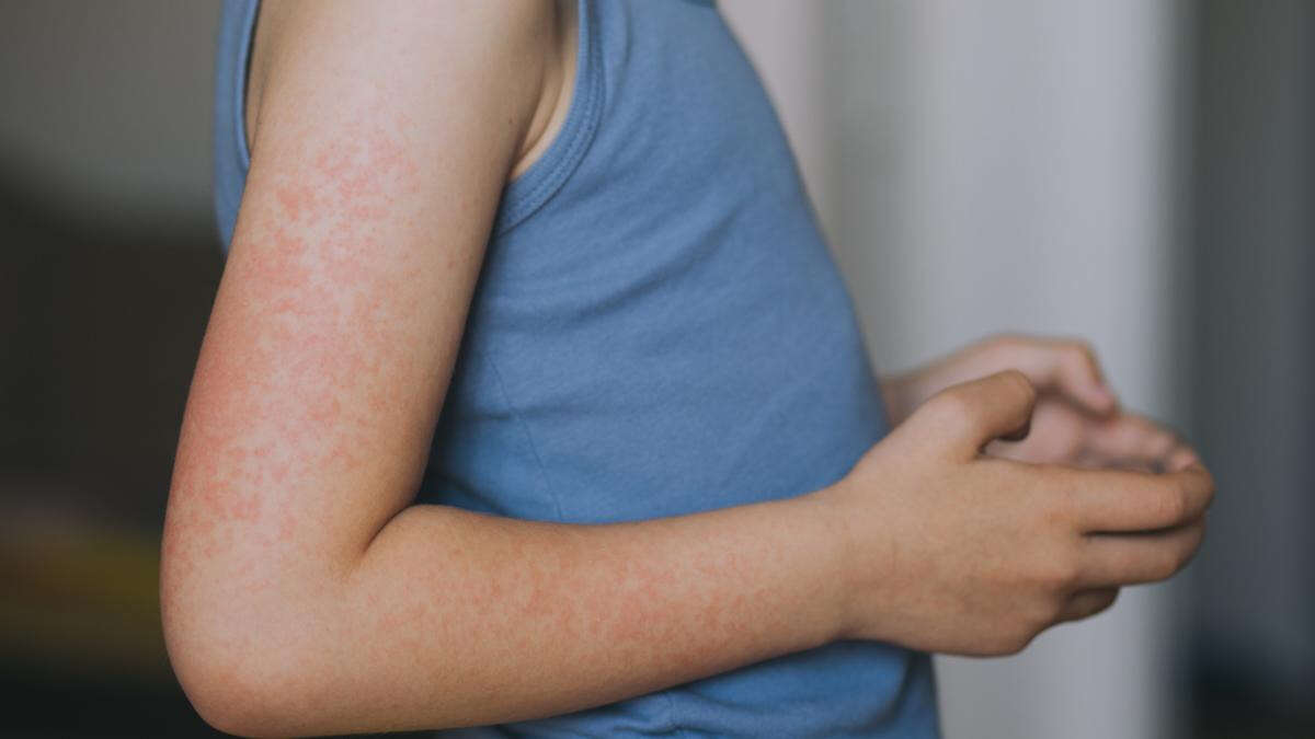 Measles alert for Western Sydney just days after Sydney CBD warning