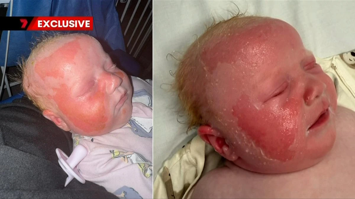 Hidden danger leaves 10-week-old baby in hospital with major burns