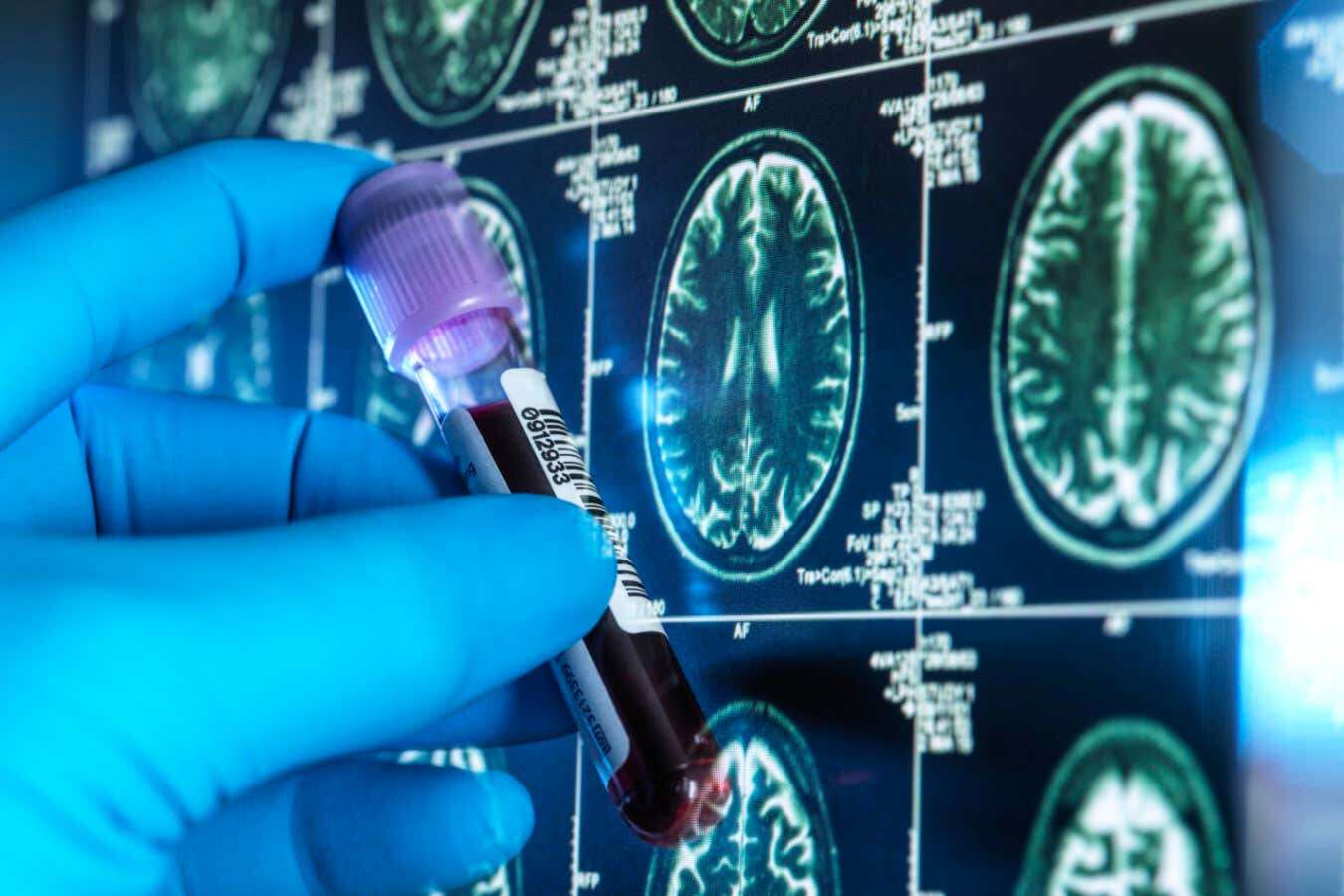 Blood tests for Alzheimer’s may be rolled out within five years