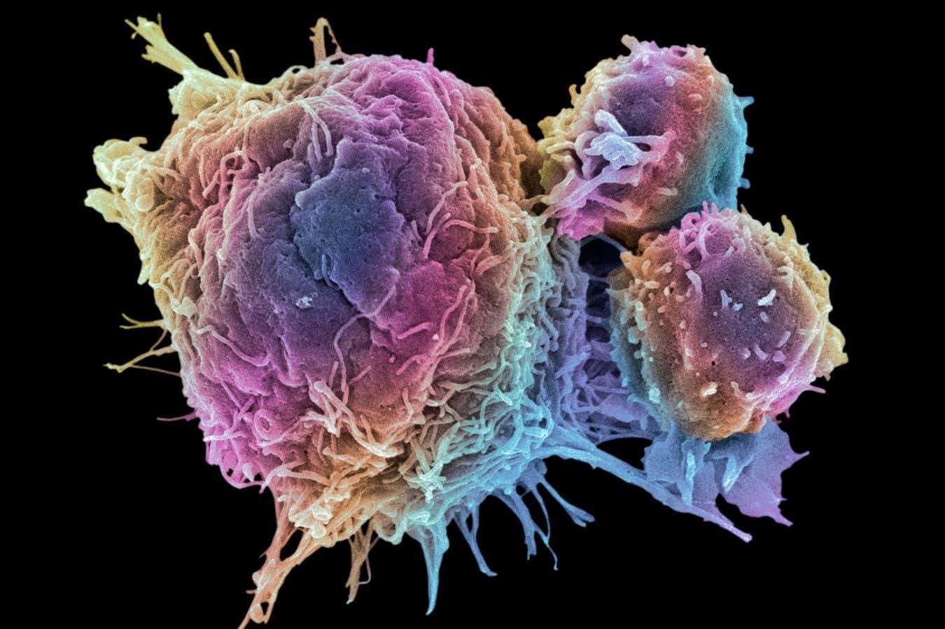 Why viewing cancer as an ecosystem could lead to better treatments