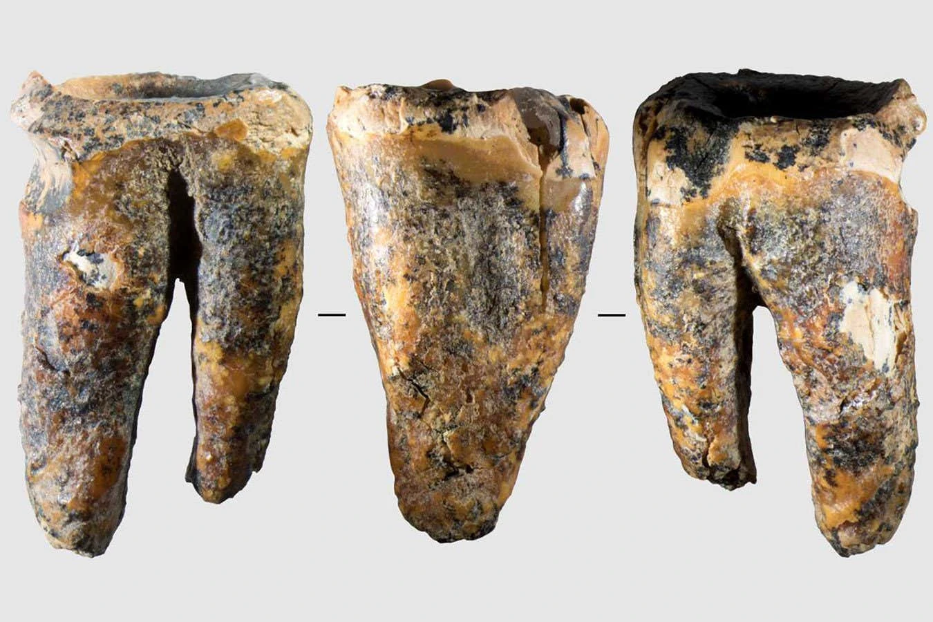 Neanderthals treated a dental cavity by drilling into the tooth