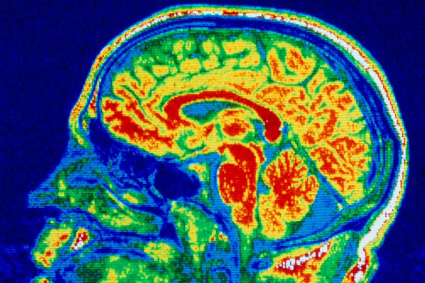 Brain changes with eating disorders similar to those in OCD and autism