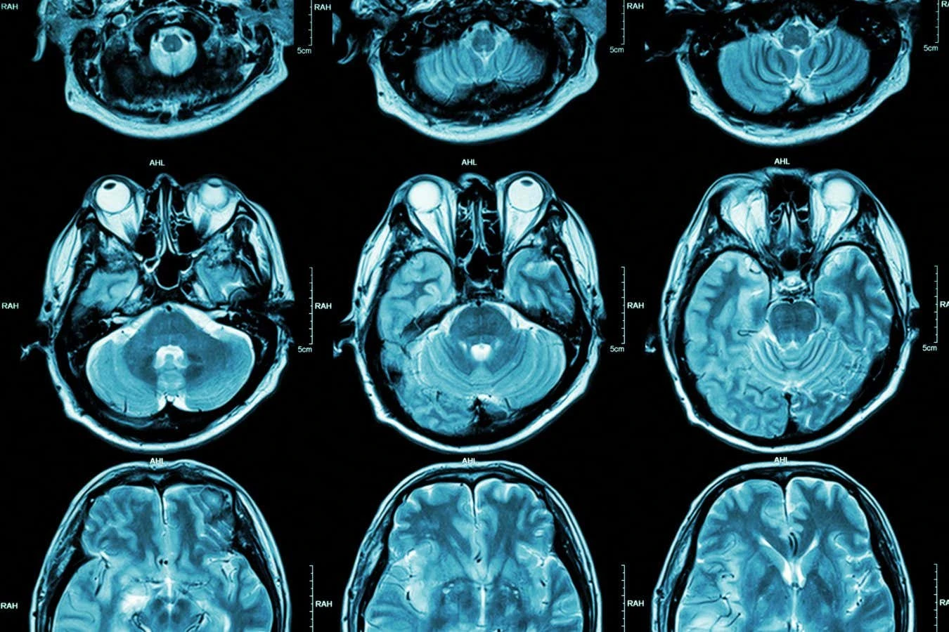 Autism may have two distinct subtypes that vary by brain activity
