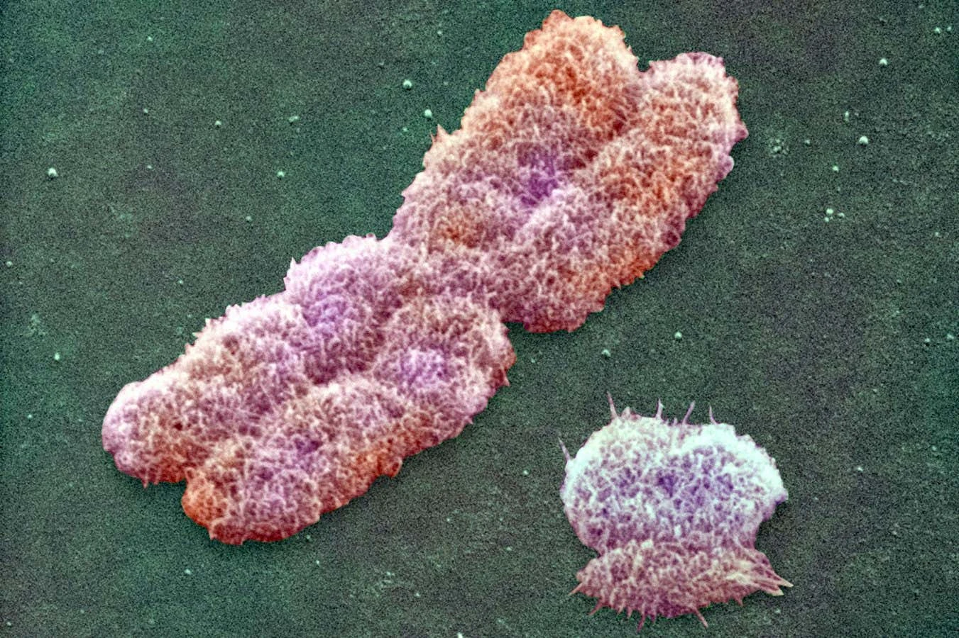 Vanishing Y chromosomes seem to be driving heart disease in men