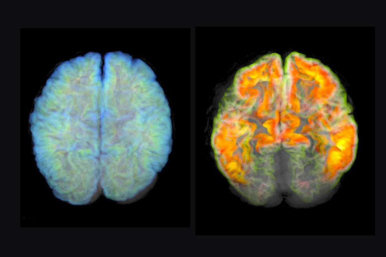 2023 saw a cautious hope for Alzheimer's treatment but doubts remain