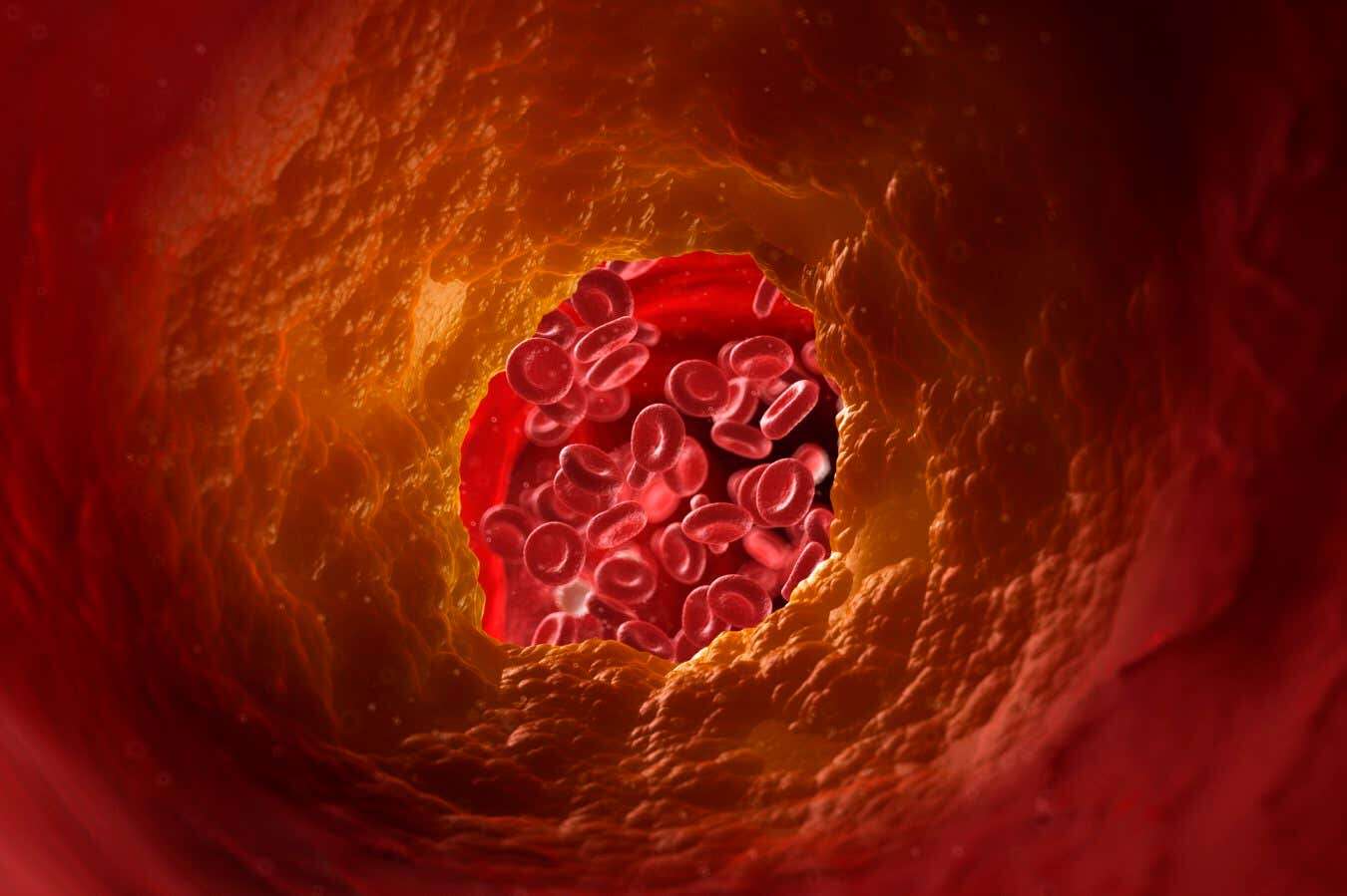 CAR T-cell therapy could help prevent clogged arteries