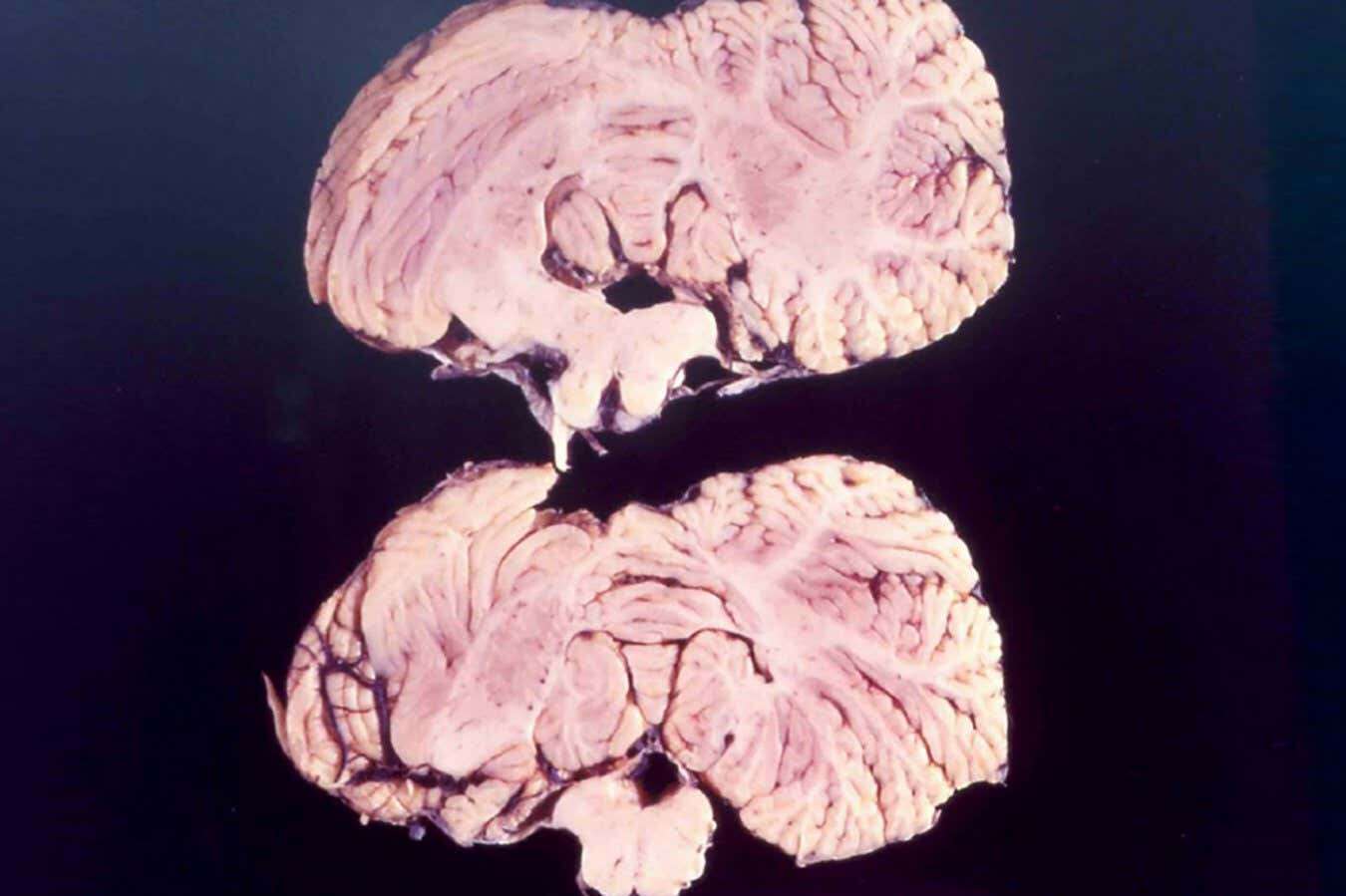 Gene variants may protect against brain disease linked to cannibalism