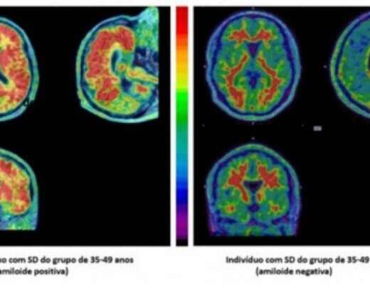 SÃ­ndrome de Down: tÃ©cnica de medicina nuclear estuda Alzheimer nesse grupo