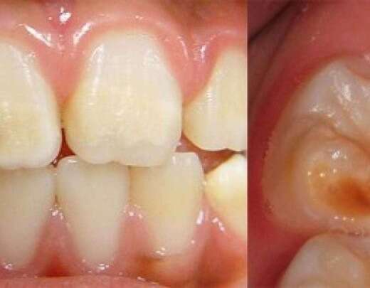 Estudo aponta fatores ligados a dentes frÃ¡geis e opacos em crianÃ§as