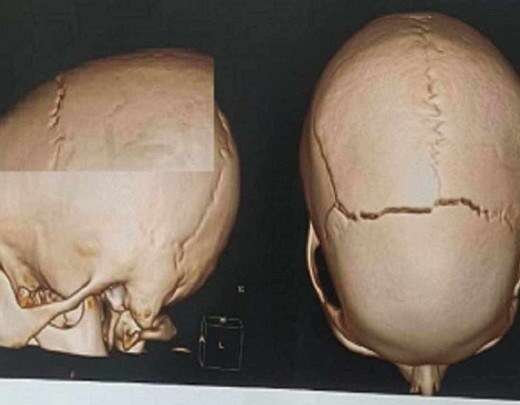 BH: homem atropela adolescente, finge socorro e foge