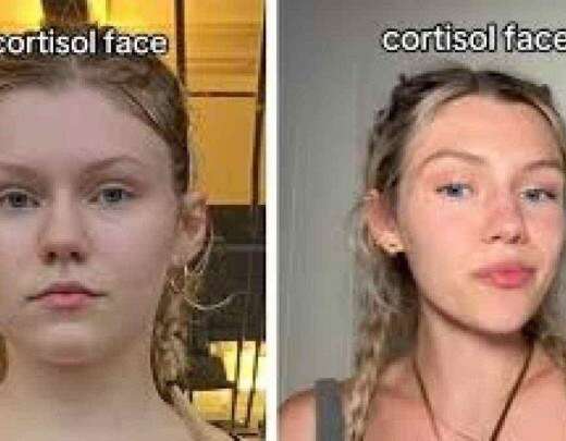 Cortisol Face: o esteroide pode modificar o rosto?