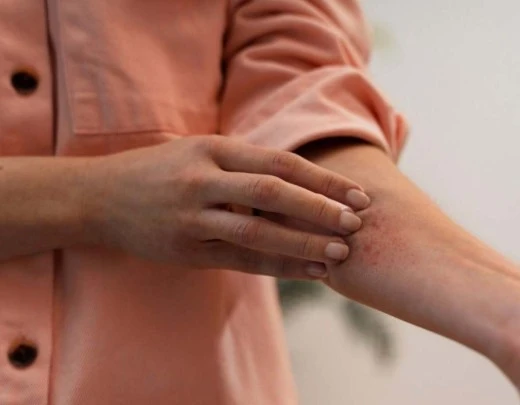Alergias de contato causam desconforto e podem ter diferentes causas
