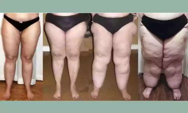 VerÃ£o: pacientes com Lipedema sÃ£o mais afetados pelas altas temperaturas