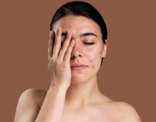 Adesivos para acne funcionam? Entenda as vantagens e desvantagens