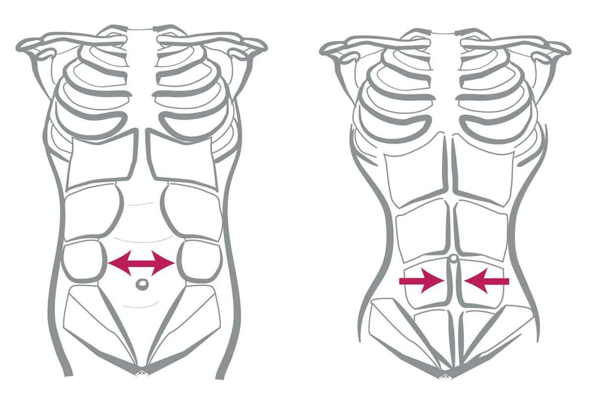Tecnologia eletromagnÃ©tica trata diÃ¡stase abdominal de forma nÃ£o invasiva