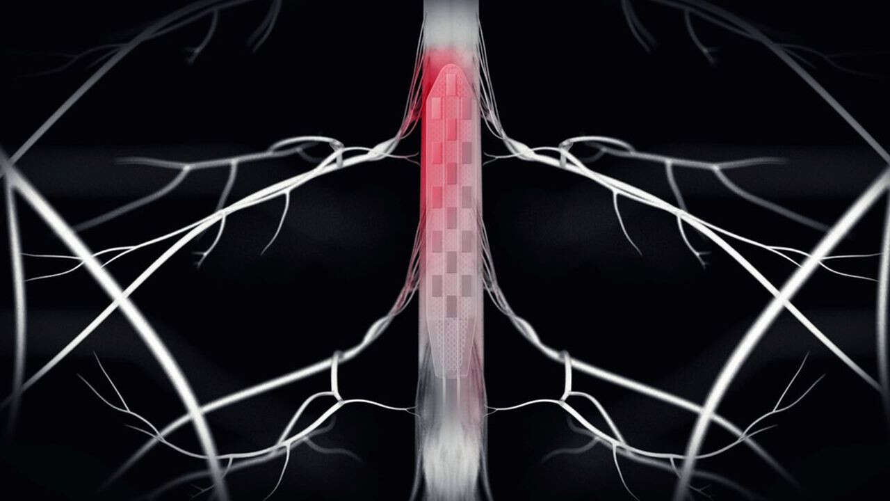 Une neuroprothèse rend l'usage normal de leurs jambes aux malades de Parkinson