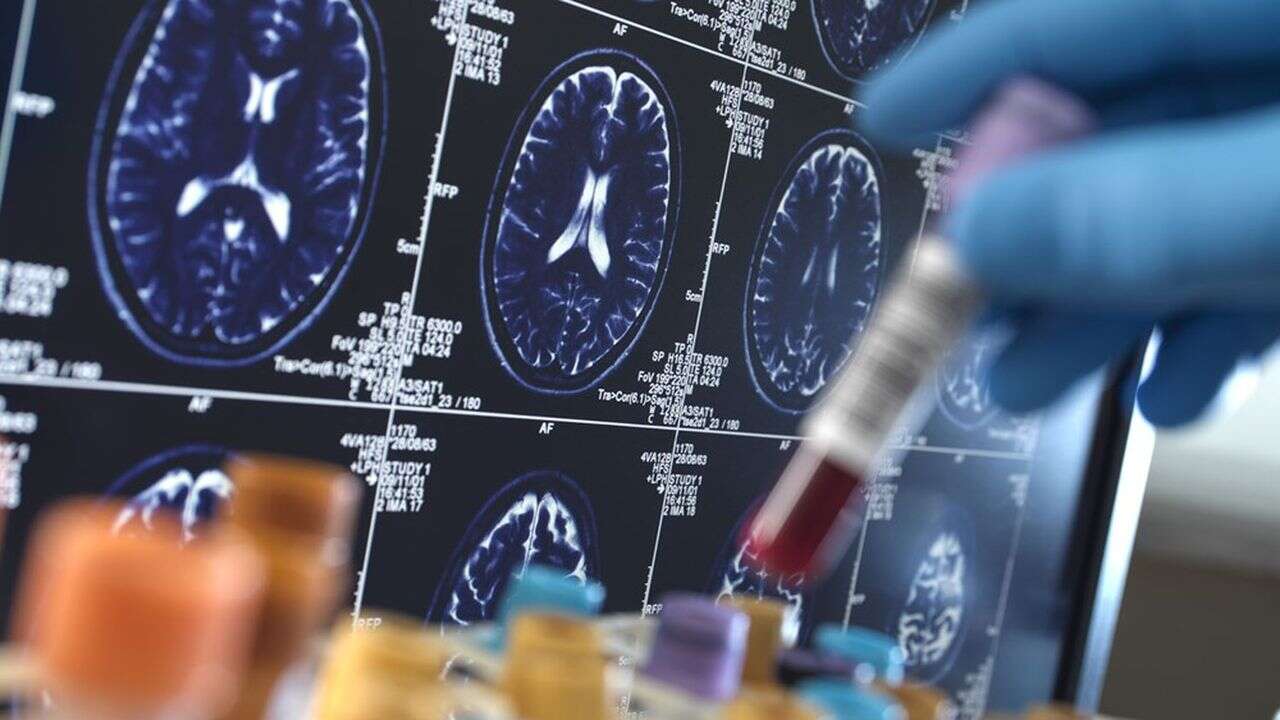 Alzheimer : feu vert pour un deuxième traitement aux Etats-Unis, le Kisunla