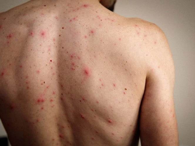 Alerta por sarampión: EU supera los mil casos confirmados en 2025