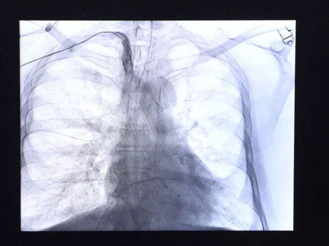 Enfermedades del corazón se mantienen como la primera causa de muerte en los mexicanos 