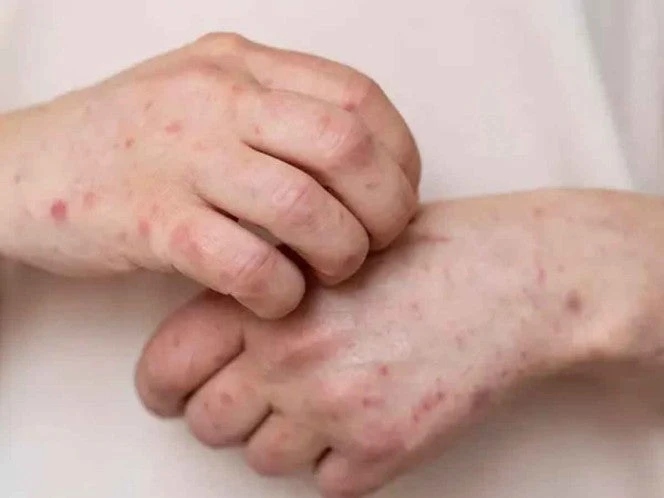 Confirman primer caso de sarampión en Hidalgo; autoridades refuerzan medidas de prevención