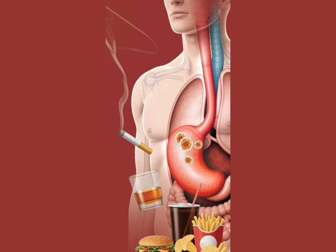 Cáncer gástrico se adelanta a los 50 años; 80% lo confunden con gastritis