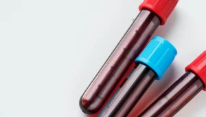 EUA aprovam uso de exame sanguíneo para detectar Alzheimer