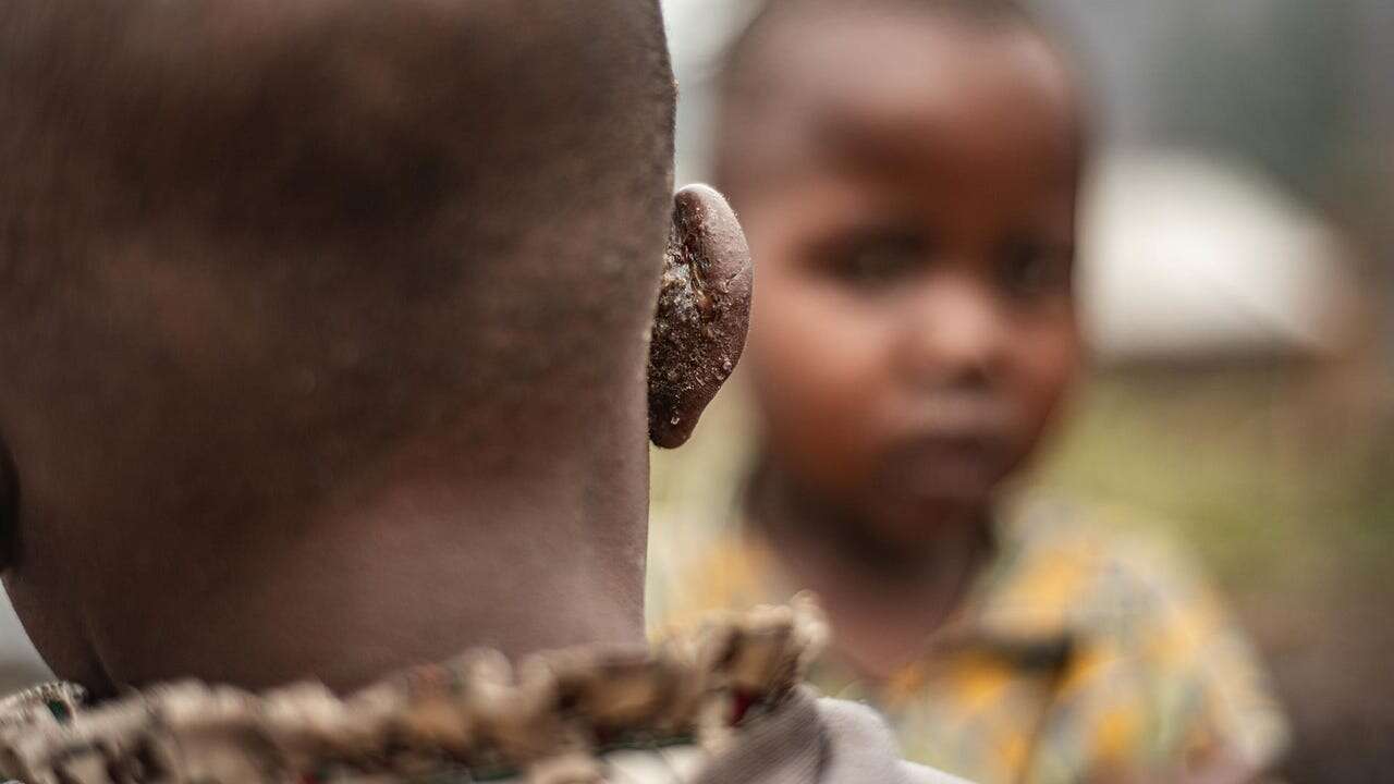 Una nueva pastilla probada en África elimina mejor los gusanos intestinales